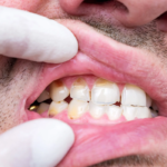 Why do enamel cracks appear and how can they be treated?